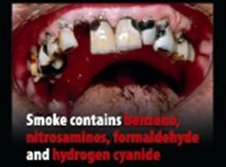 rotting_teeth_126149a_619010.jpg
