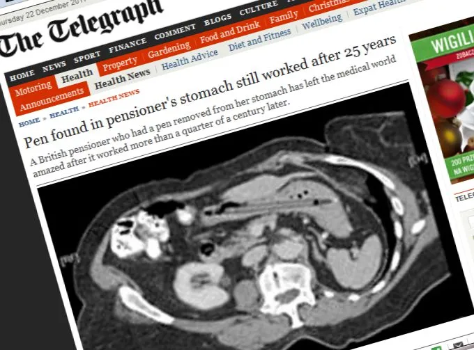 Chodziła ćwierć wieku z długopisem w... brzuchu