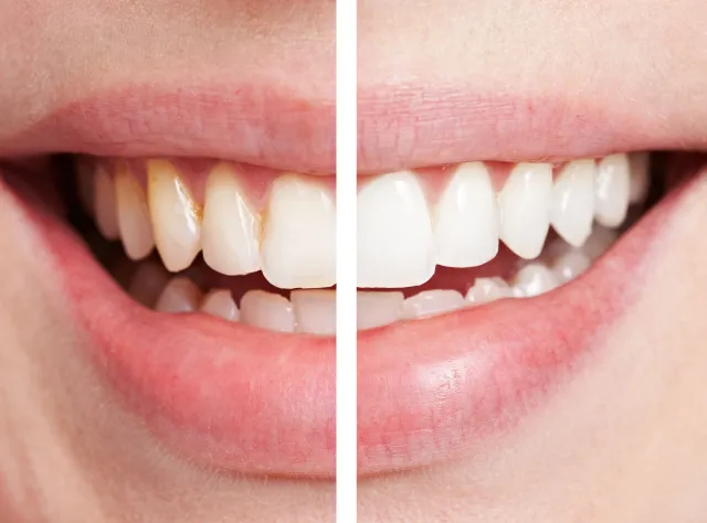 Wybielanie zębów w domu i gabinecie dentysty. Jaką metodę wybrać?