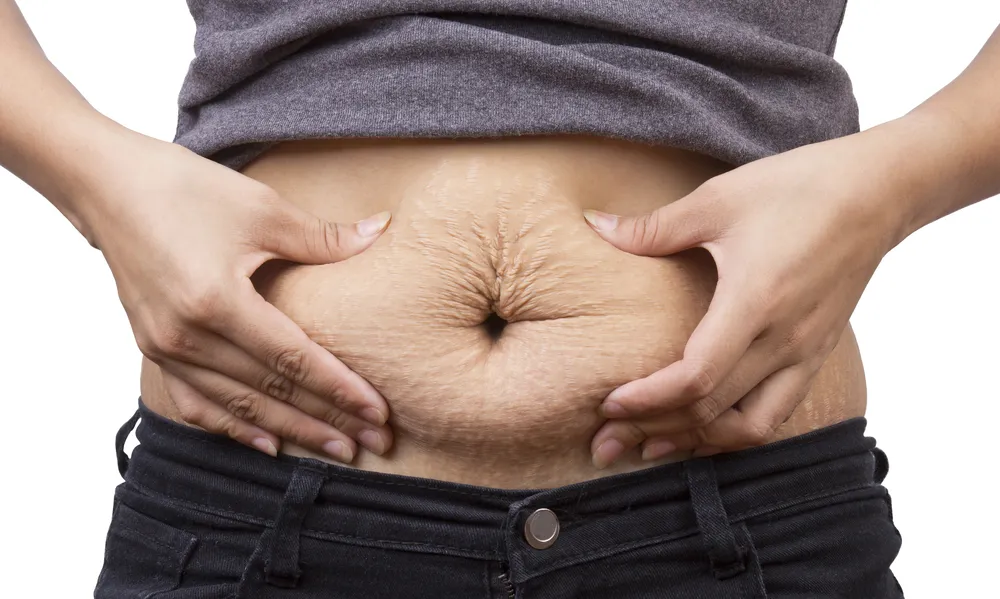 Rozstępy na brzuchu