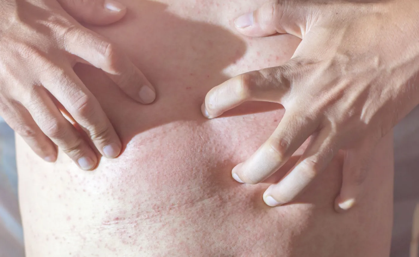 Potówki czy może wysypka? Jak odróżnić zmiany na skórze?