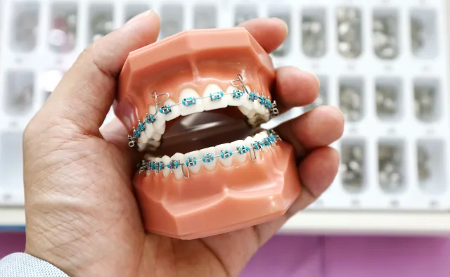 Aparaty ortodontyczne dla dzieci i nastolatków – jaki wybrać?