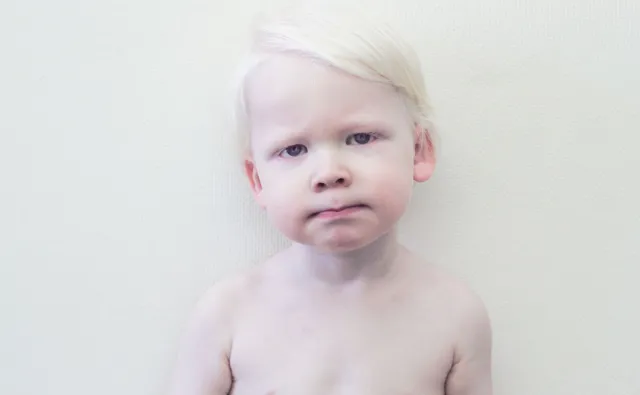 Porcelanowi ludzie. Jak żyje się z albinizmem?