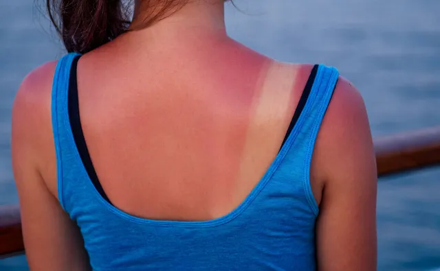 Oparzenia słoneczne są najczęstszą przyczyną rozwoju czerniaka