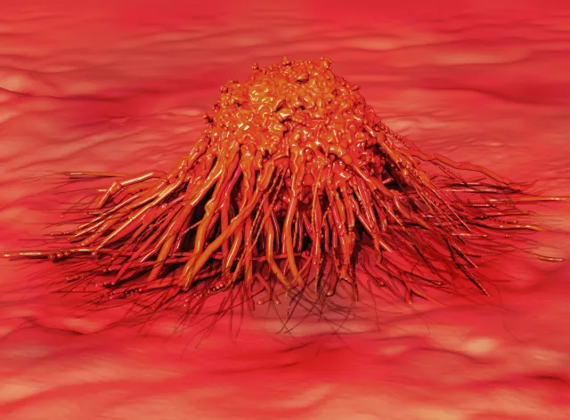 Trzustki, pęcherzyka żółciowego... 10 najbardziej śmiertelnych nowotworów