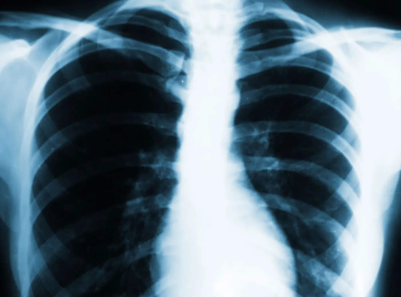 gruźlica płuca rentgen