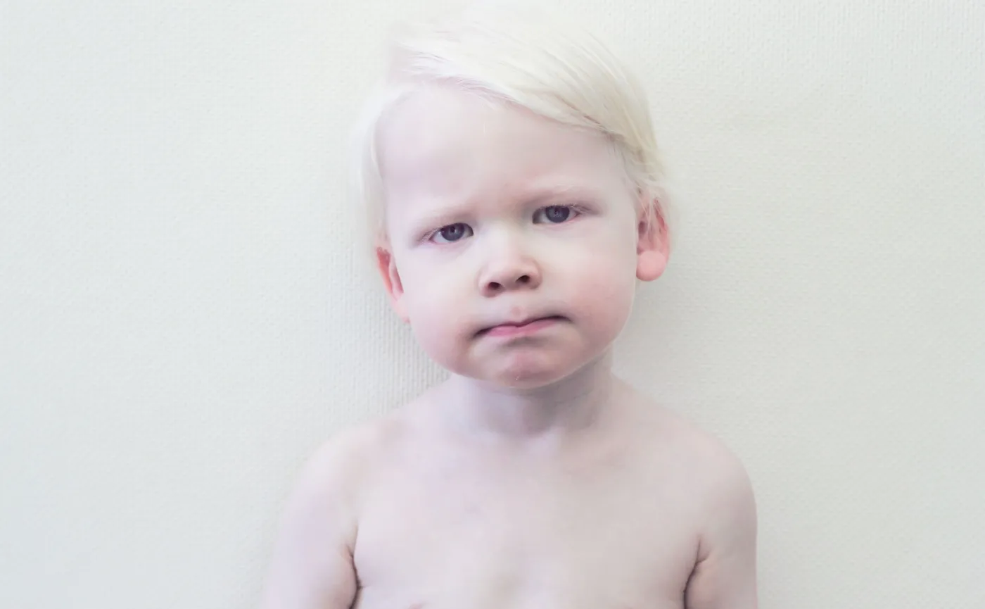 Dziecko z albinizmem