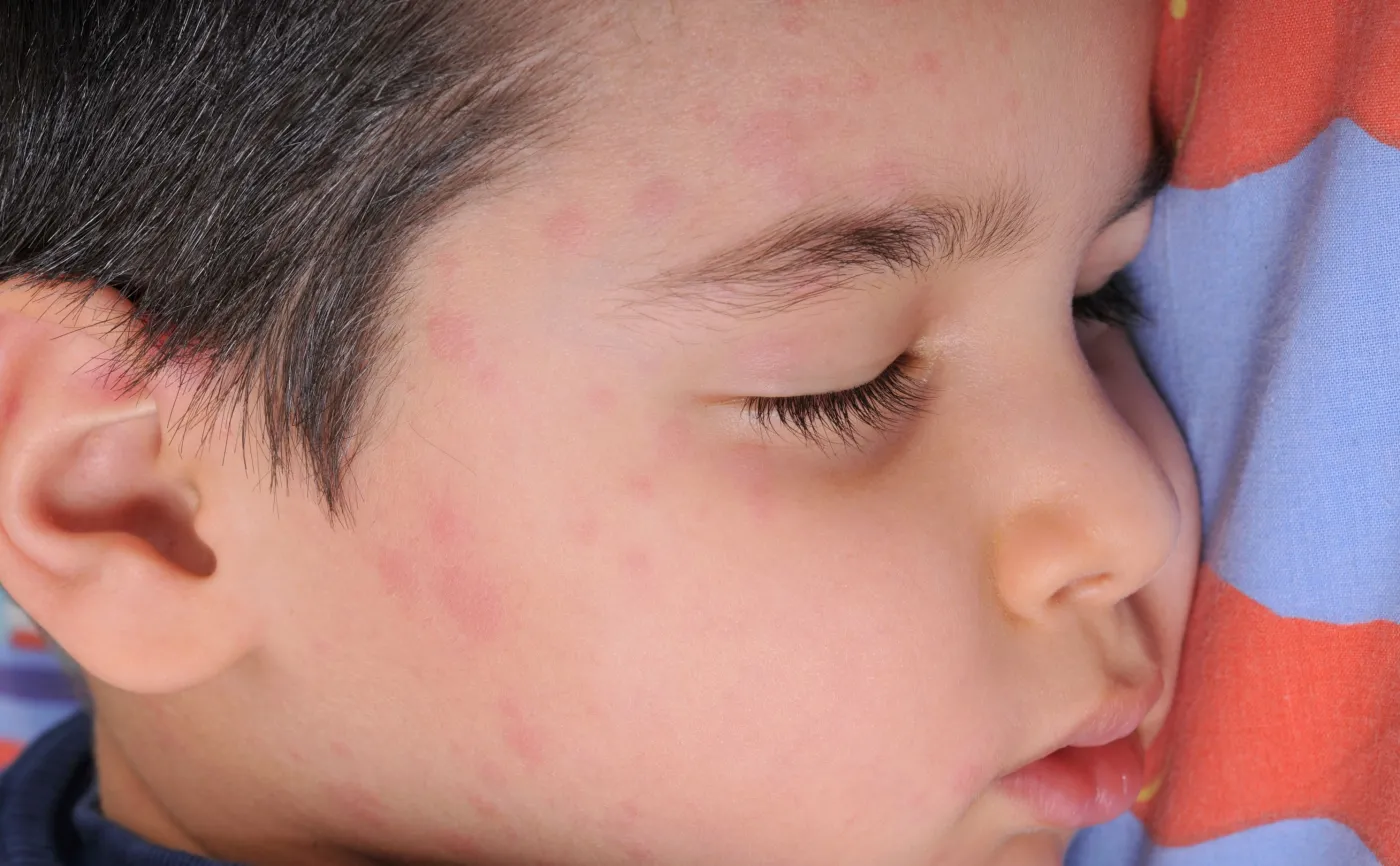 Dziecko chore na odrę