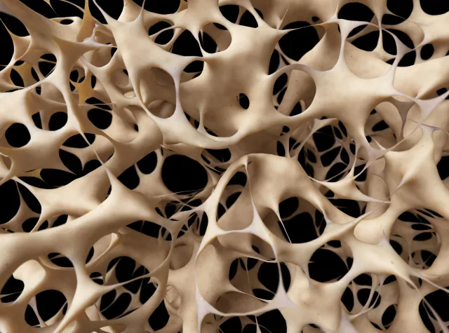 OSTEOPOROZA to zaniedbany problem. Dotyczy 3 milionów Polaków