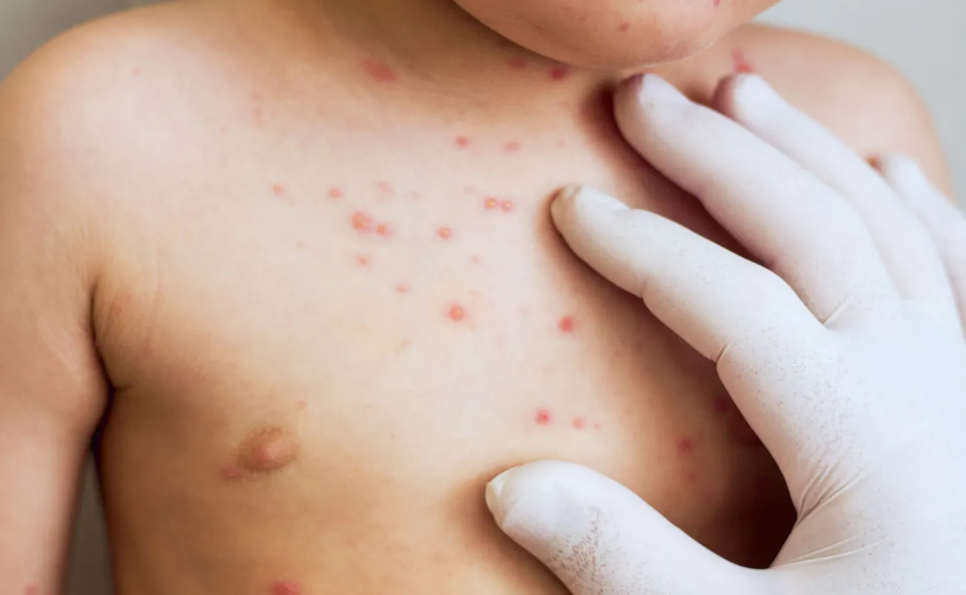 Lekarz ogląda wysypkę