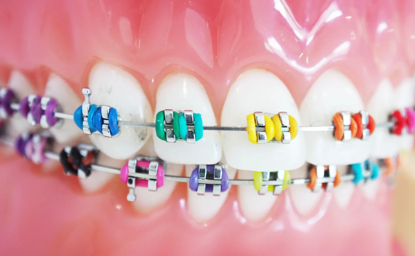 Aparat ortodontyczny