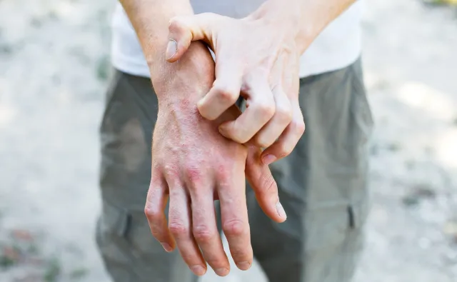 Eksperci: Chorzy na atopowe zapalenie skóry potrzebują terapii biologicznej