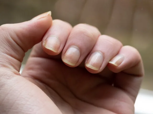 Na co chorują paznokcie? OBJAWY, których nie można bagatelizować