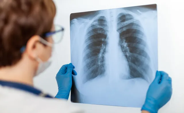 Na podstawie zdjęcia RTG można przewidzieć powikłania po COVID-19