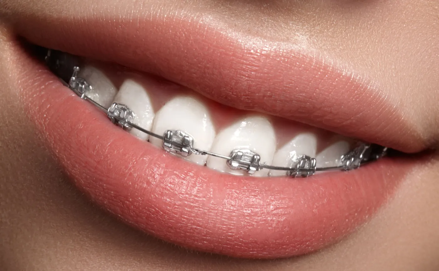 Ile kosztuje aparat ortodontyczny? Jaki wybrać?