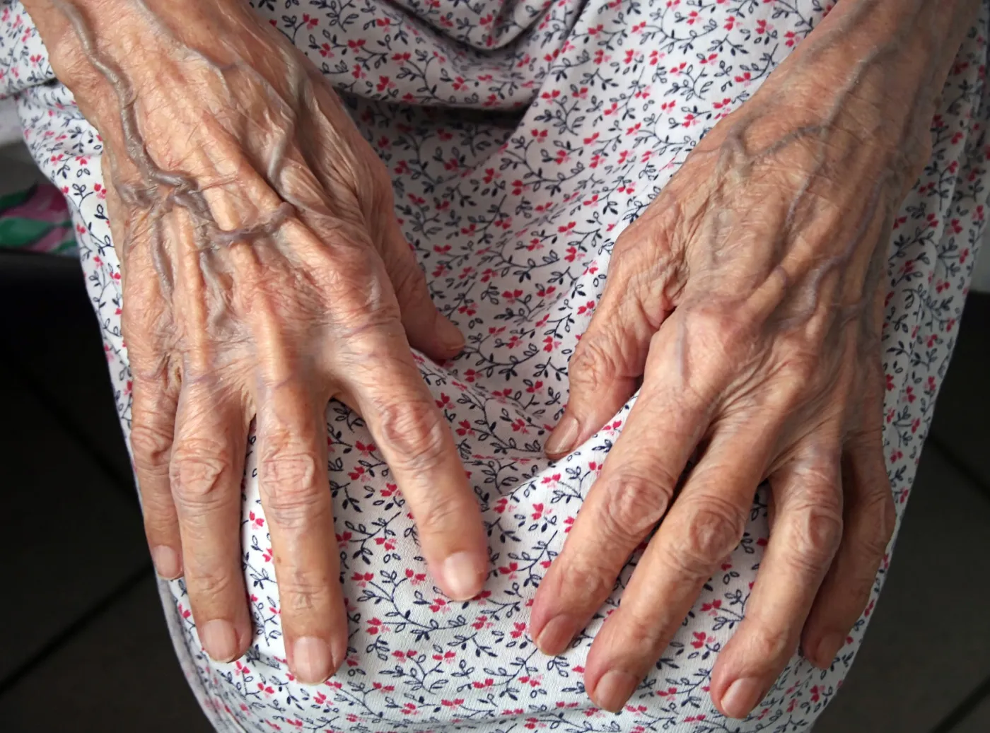 Przełom! Proste badanie wykaże alzheimera