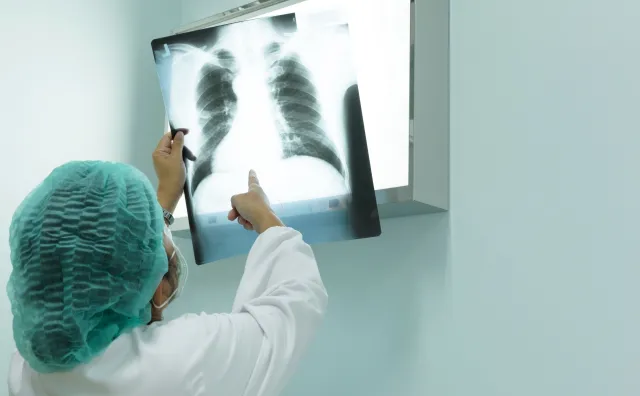 RAK PŁUCA - najczęstszy nowotwór złośliwy. Co roku 23 tys. Polaków słyszy tę diagnozę