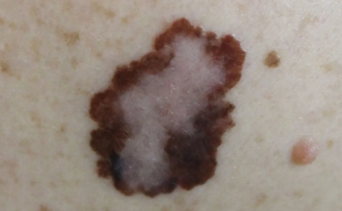 Czerniak, rak skóry