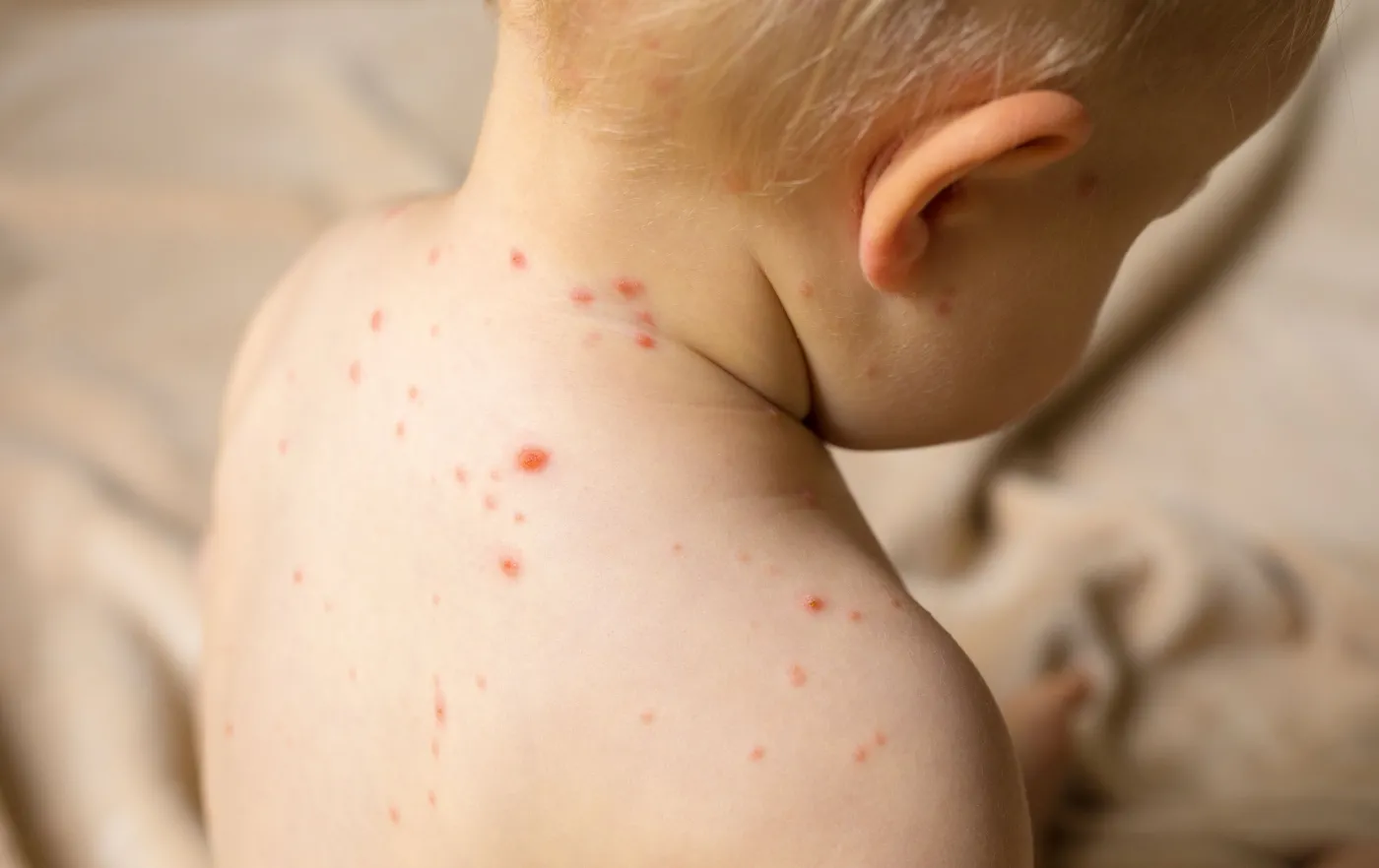 Rośnie liczba przypadków zachorowań na ospę wietrzną