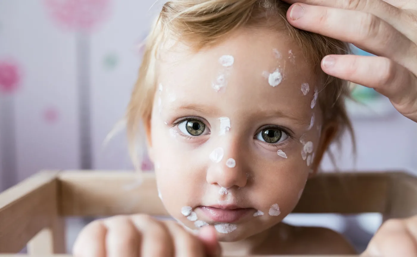 Dziecko chore na ospę