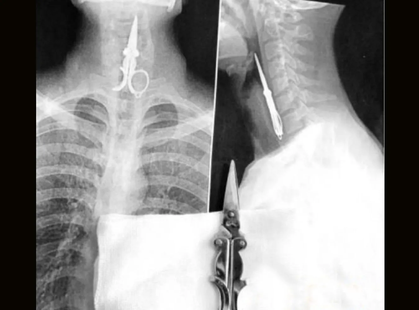 O mało nie połknął nożyczek