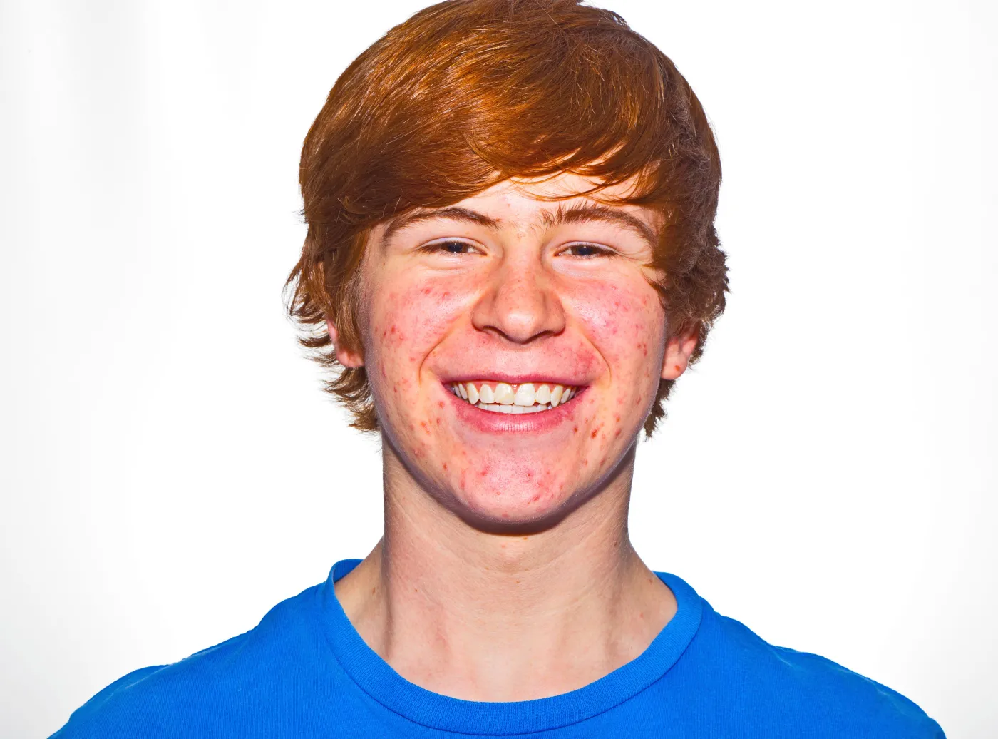 trądzik pryszcze pryszcz