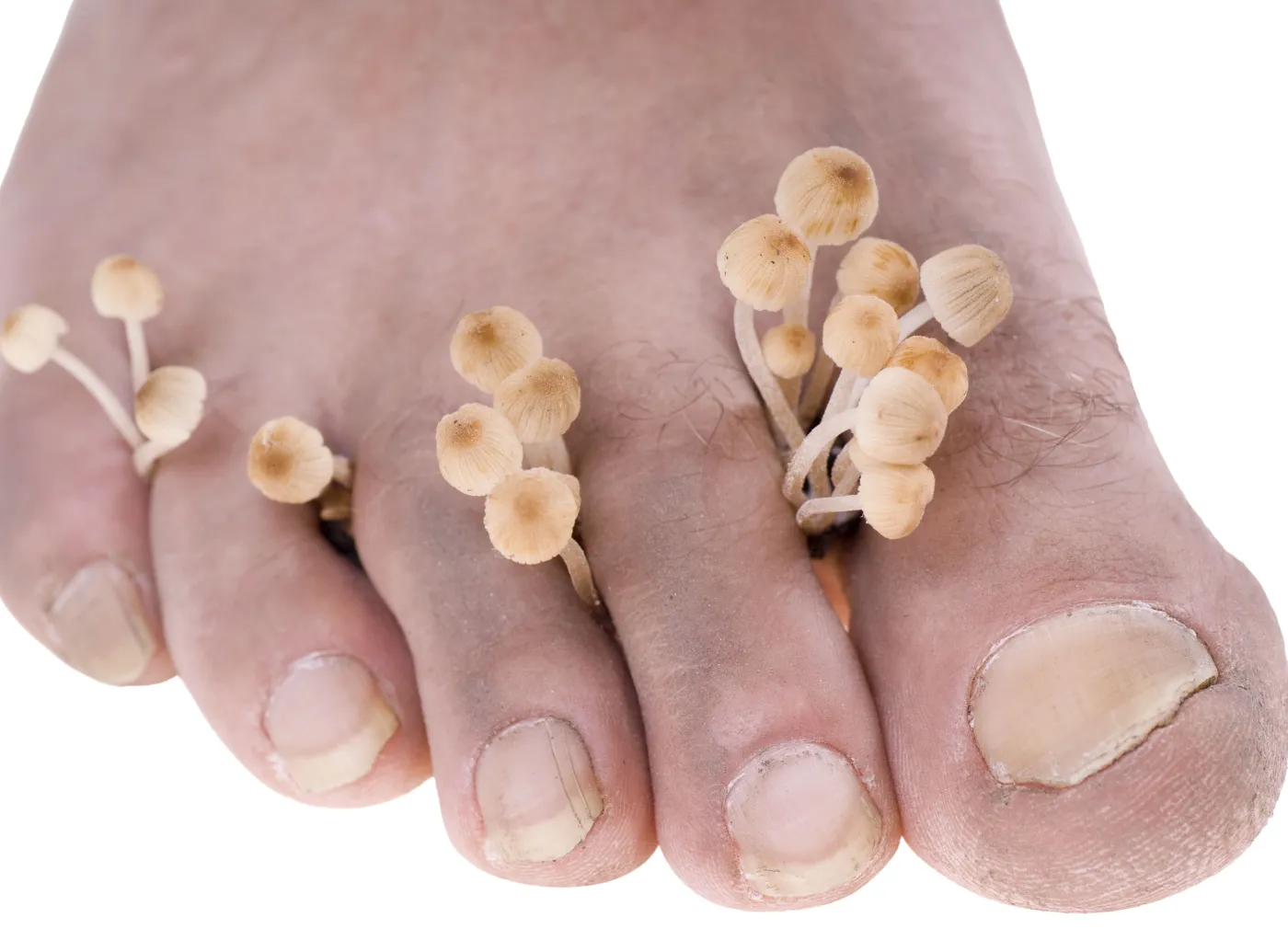3492793-stopy-paznokcie-grzybica.jpg