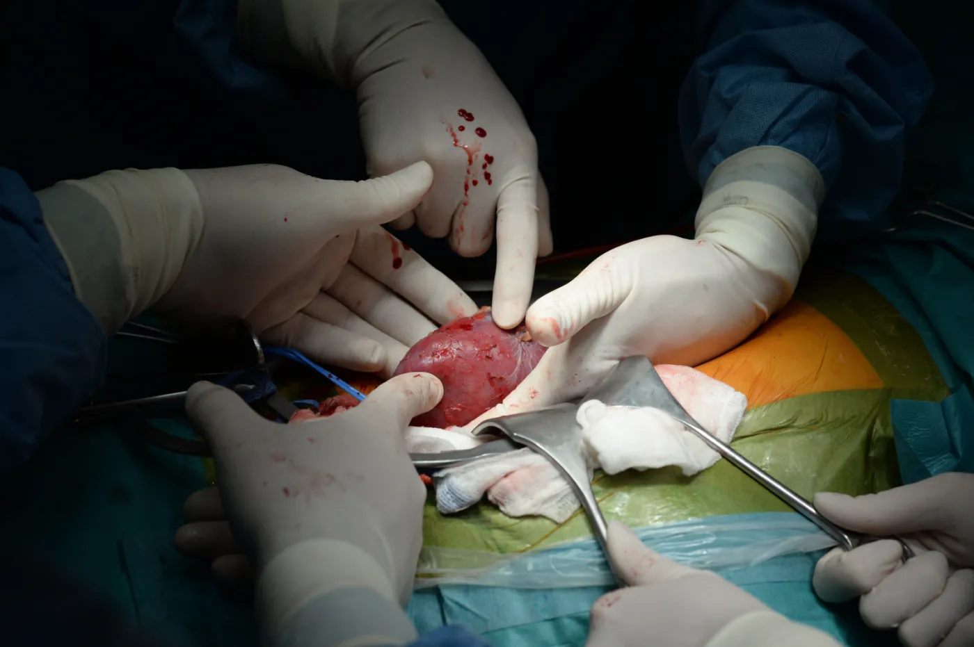 Pary wymieniły się nerkami. Pierwszy taki przeszczep w Polsce. ZDJĘCIA