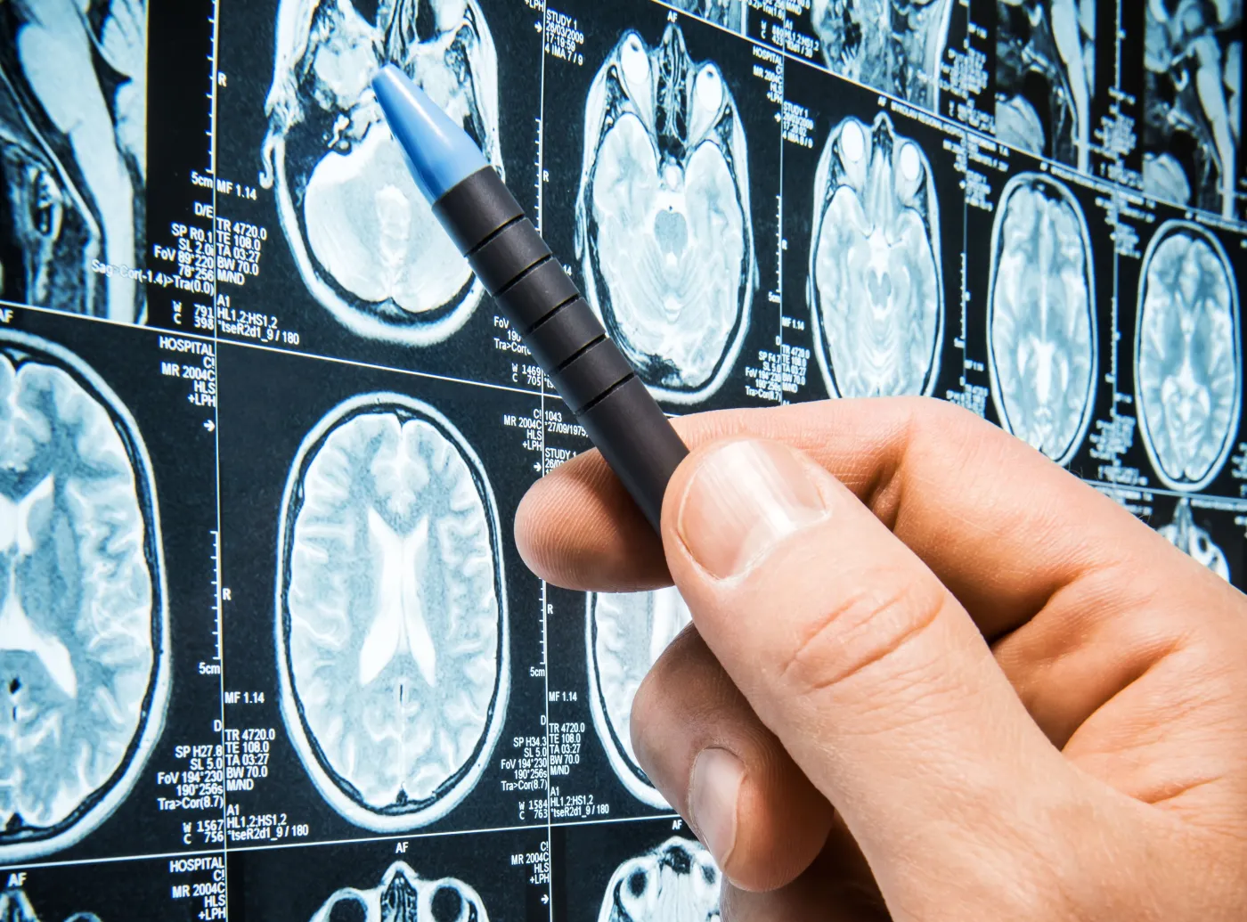 Rezonans magnetyczny mózgu