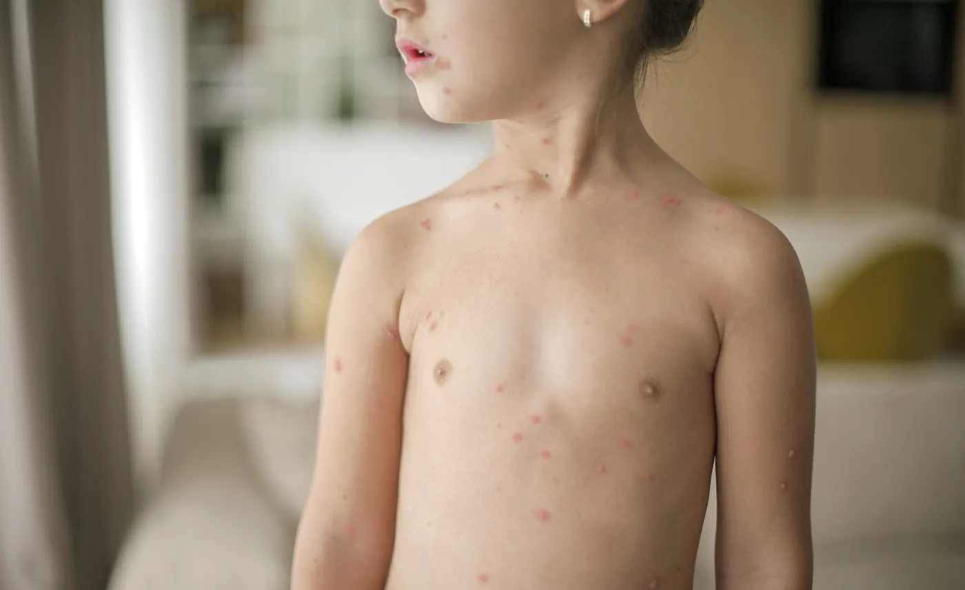 Wysypka na ciele dziecka