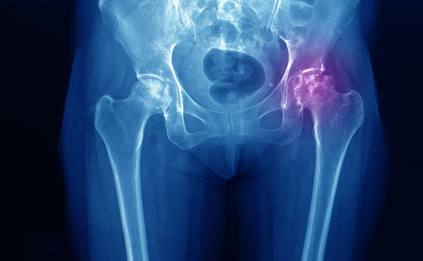 Kość udowa, miednica