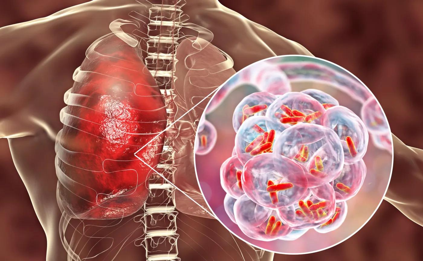 Legionella, legionelloza