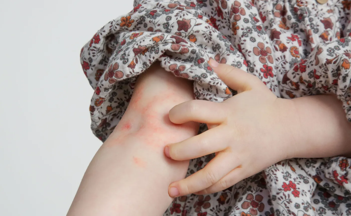 Atopowe zapalenie skóry to nie prosta wysypka. Czy pomaga dieta eliminacyjna?