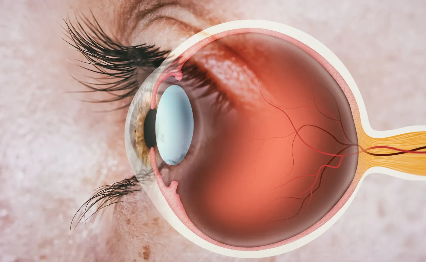 Zespół suchego oka pod lupą naukowców. Jak gruczoły łzowe z komórek macierzystych pomagają zrozumieć chorobę i szukać nowych terapii