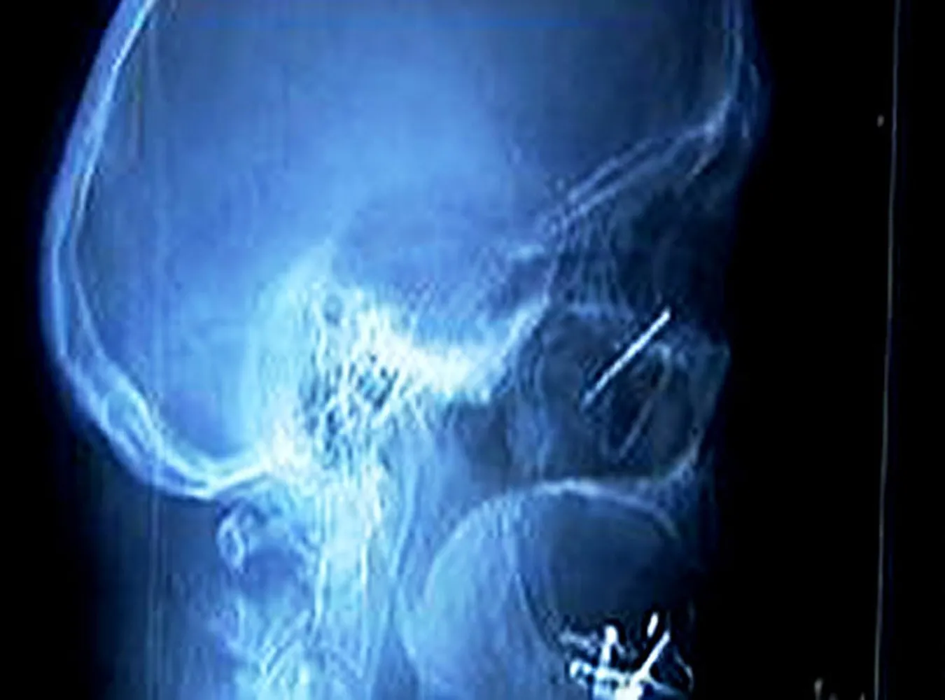 Wykaszlał calowego gwoździa