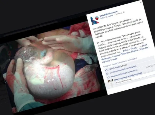 Noworodek w worku owodniowym