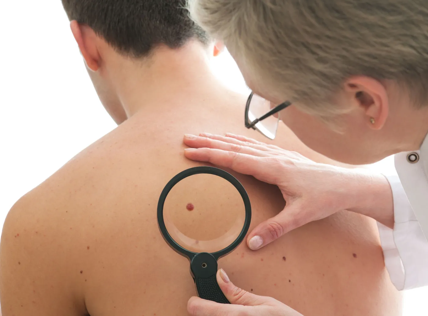 Badanie pieprzyka na skórze