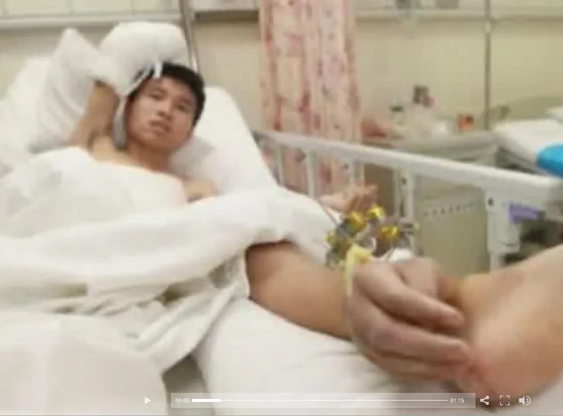 Ręka przeszczepiona na nogę