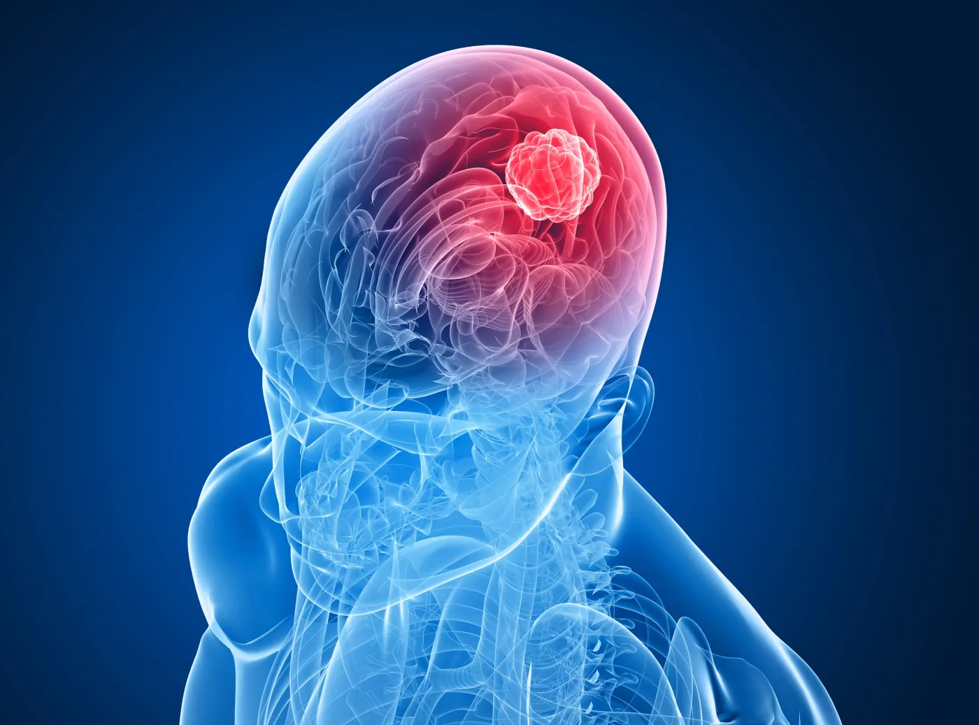 nowotwór mózg głowa rak guz