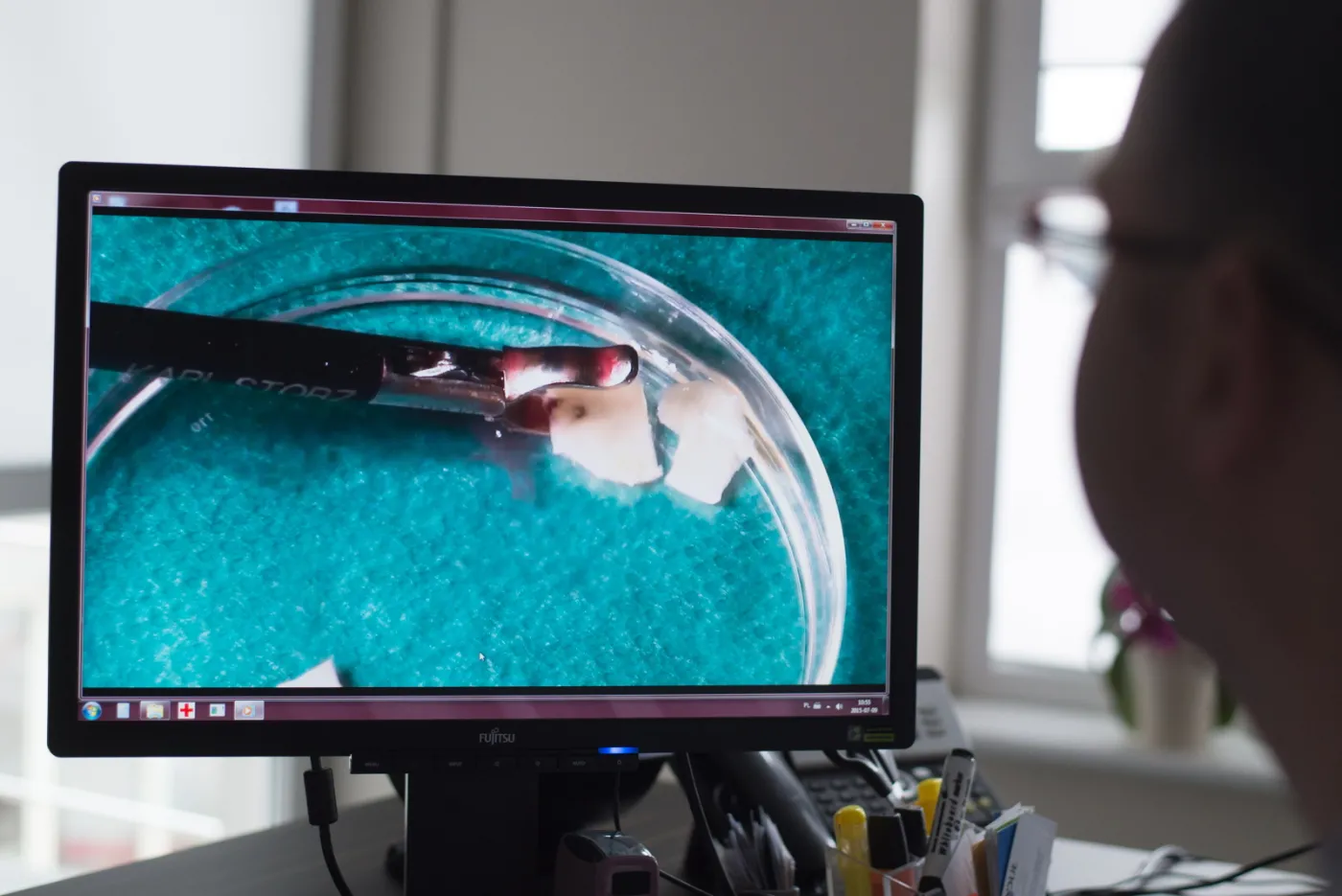  Kierownik projektu dr n. med. Paweł Radwan opowiada o nowatorskim, pierwszym w Polsce zabiegu przeszczepu tkanki jajników