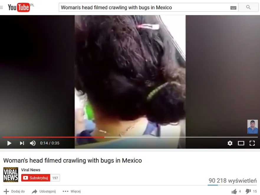 Włosy tej kobiety ruszają się od robactwa... Szokujące WIDEO podbija Internet