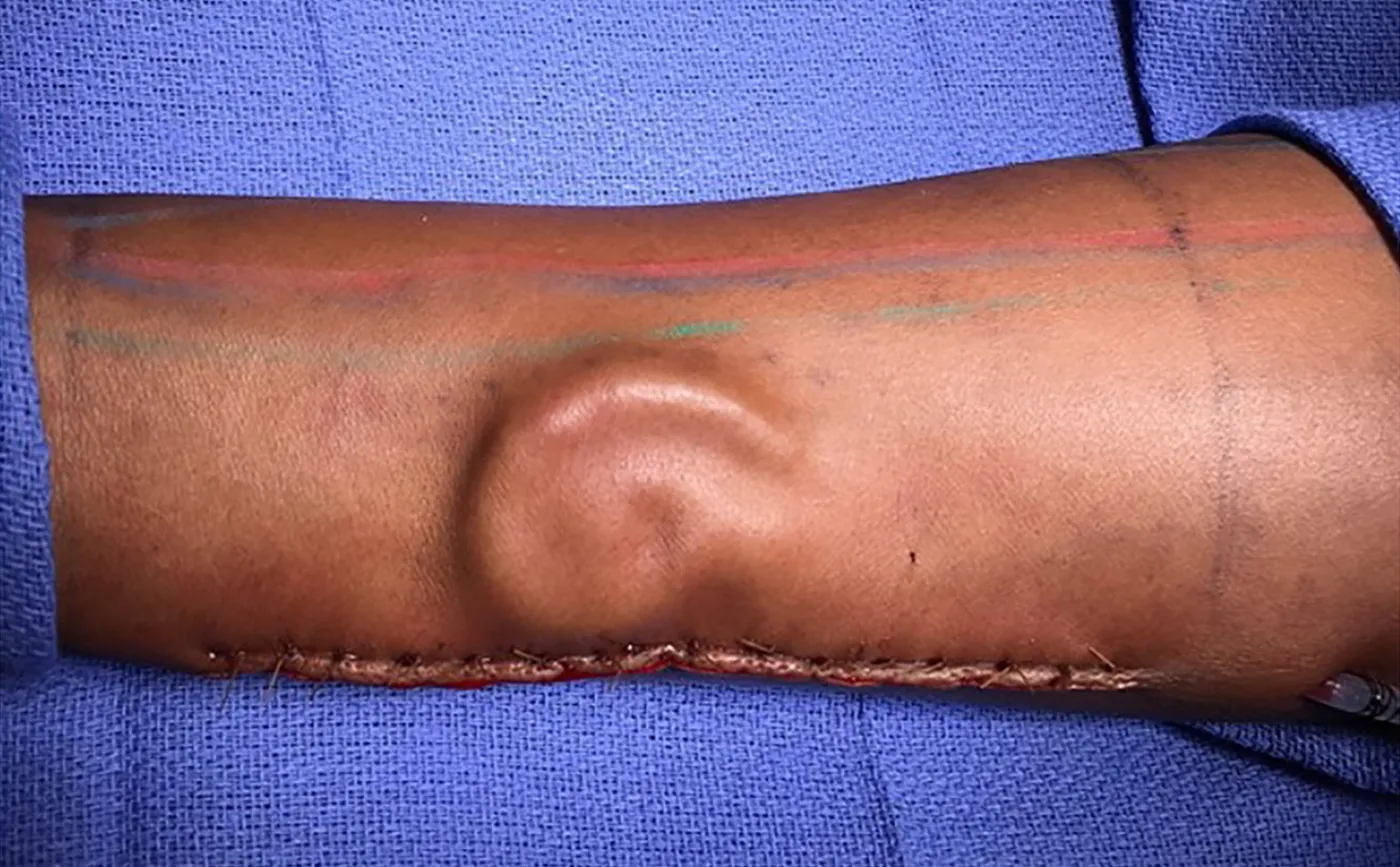 Ucho odrasta w przedramieniu