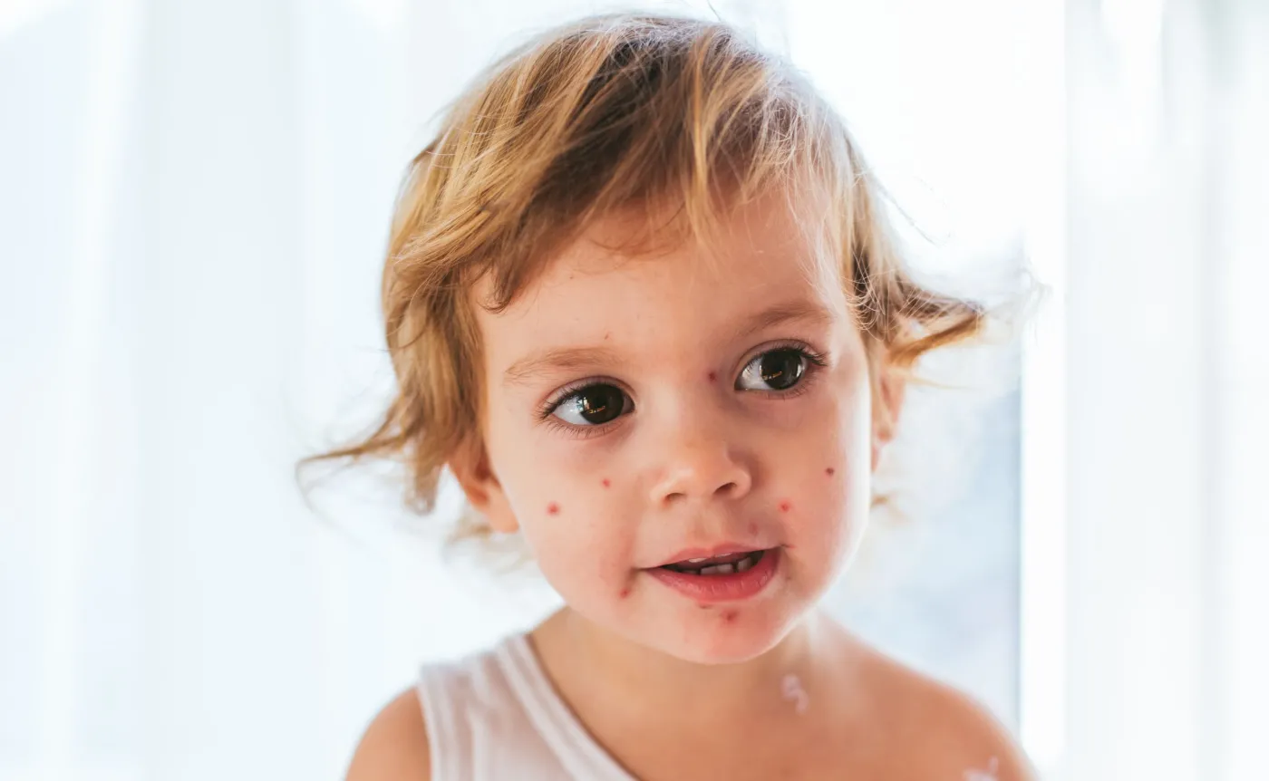 W tym roku potwierdzono w Polsce 69 tys. przypadków ospy. Rok temu - 20 tys.