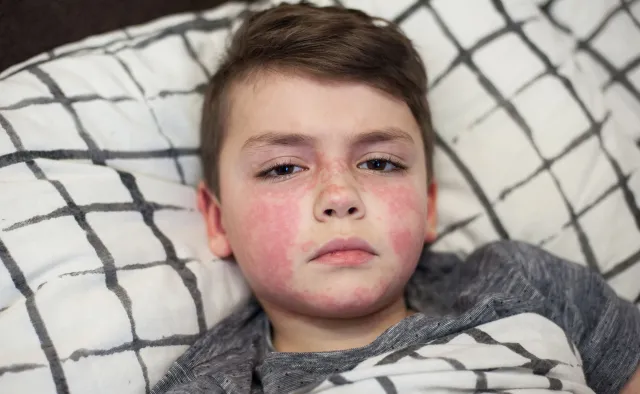 Liczba zanotowanych przypadków szkarlatyny w grudniu wzrosła ośmiokrotnie