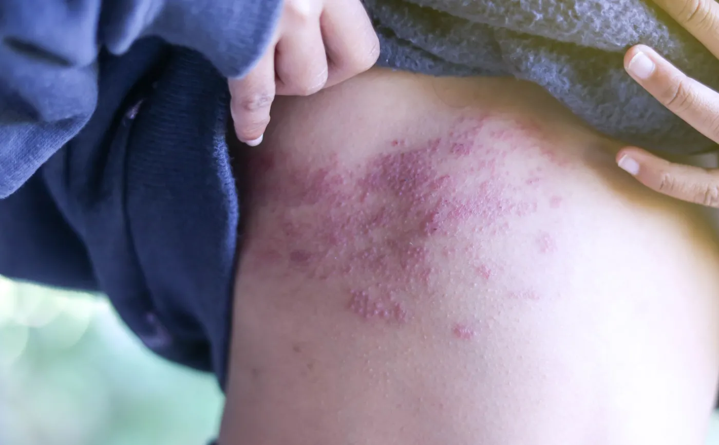 Półpasiec, wysypka