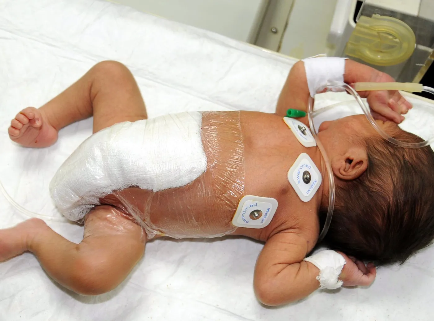 noworodek z sześcioma nogami po operacji