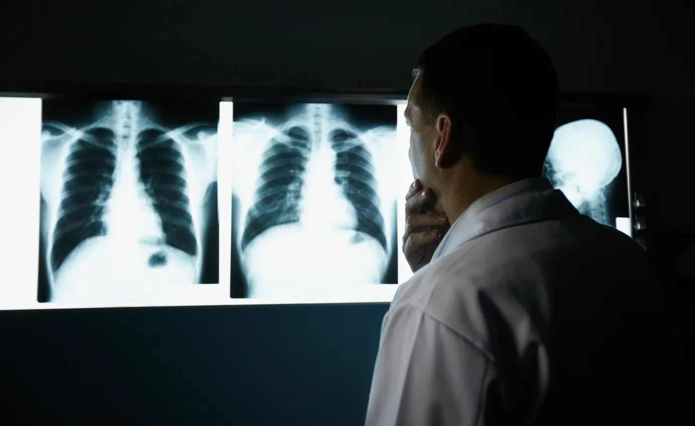 Zdjęcia rentgenowskie nowotworu płuc