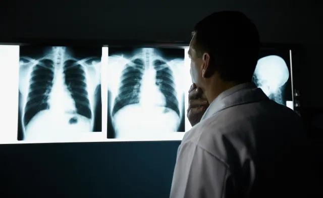 Immunoterapia. Nowa nadzieja w leczeniu agresywnego raka płuca