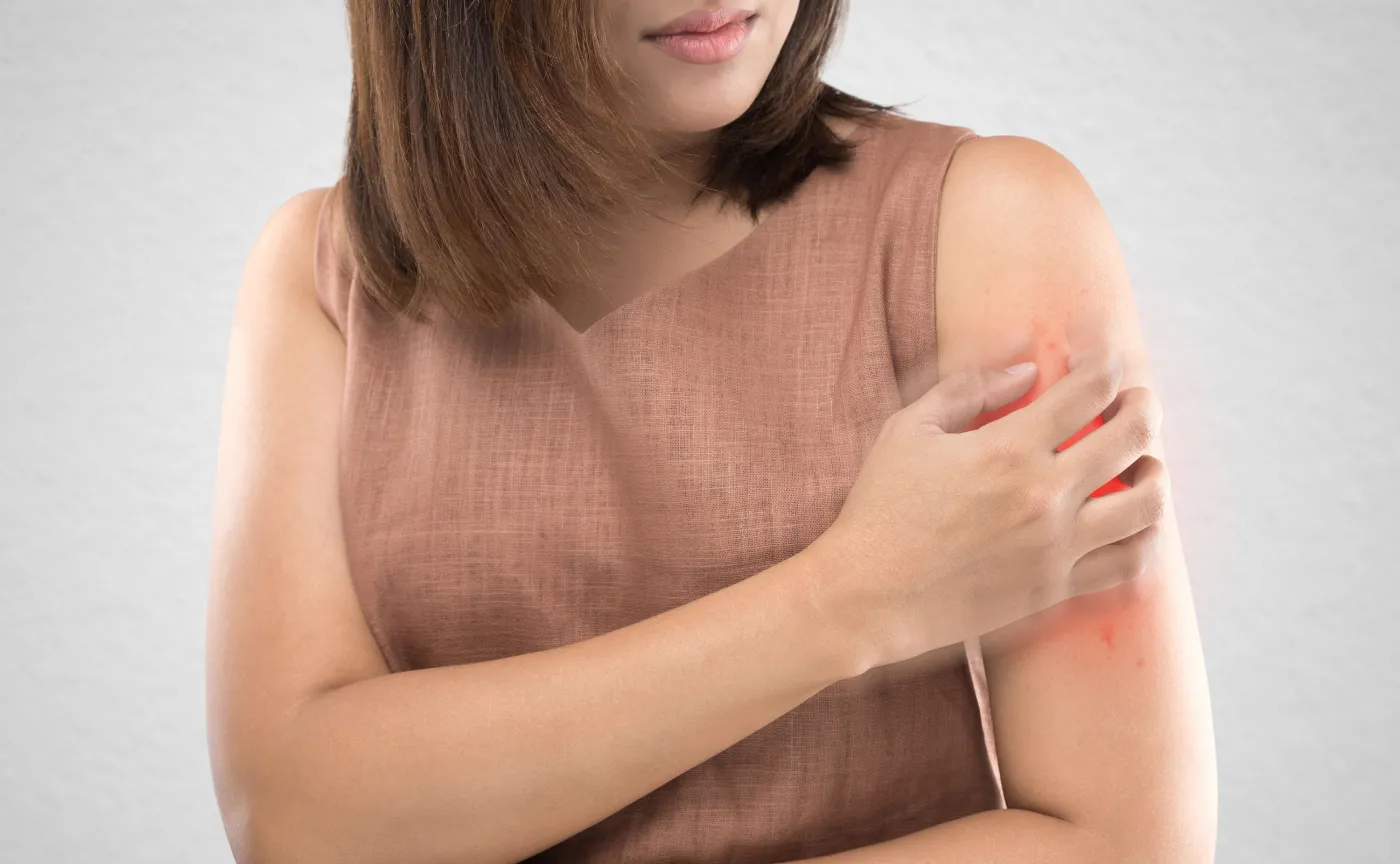 Czy to świerzb? I jak się go szybko pozbyć?