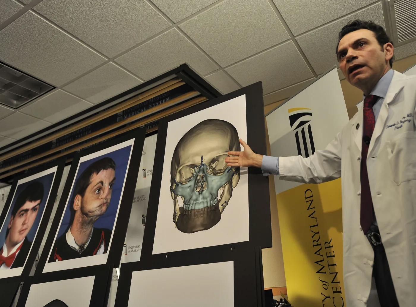 transplantacja Richard Lee Norris twarz rekonstrukcja